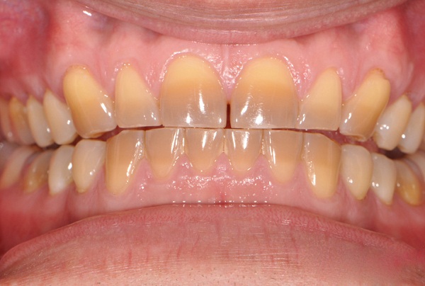Tẩy trắng răng Laser Whitening có hiệu quả như thế nào? 2