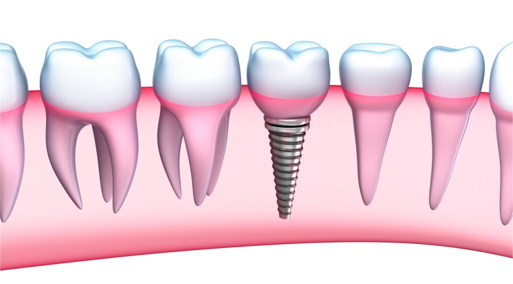 Trồng răng sứ vĩnh viễn đảm bảo an toàn 4