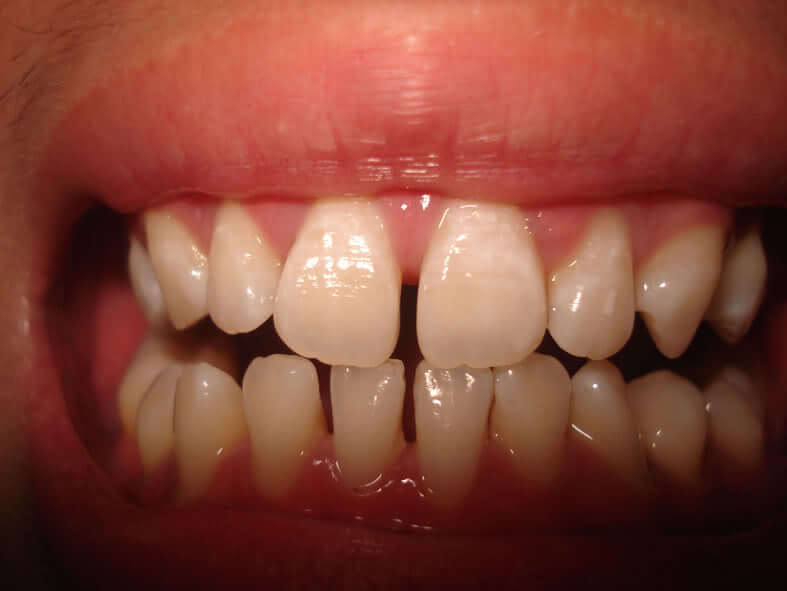 Thực hiện bọc răng sứ cho răng bị thưa được hay không? 1