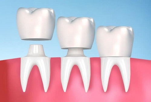 Kỹ thuật bọc răng sứ có đau không? 2