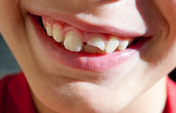 Tìm hiểu bọc răng sứ cho răng hàm 1
