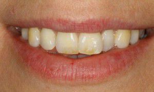 3 phút tìm hiểu về giá bọc răng sứ veneer thẩm mỹ 3