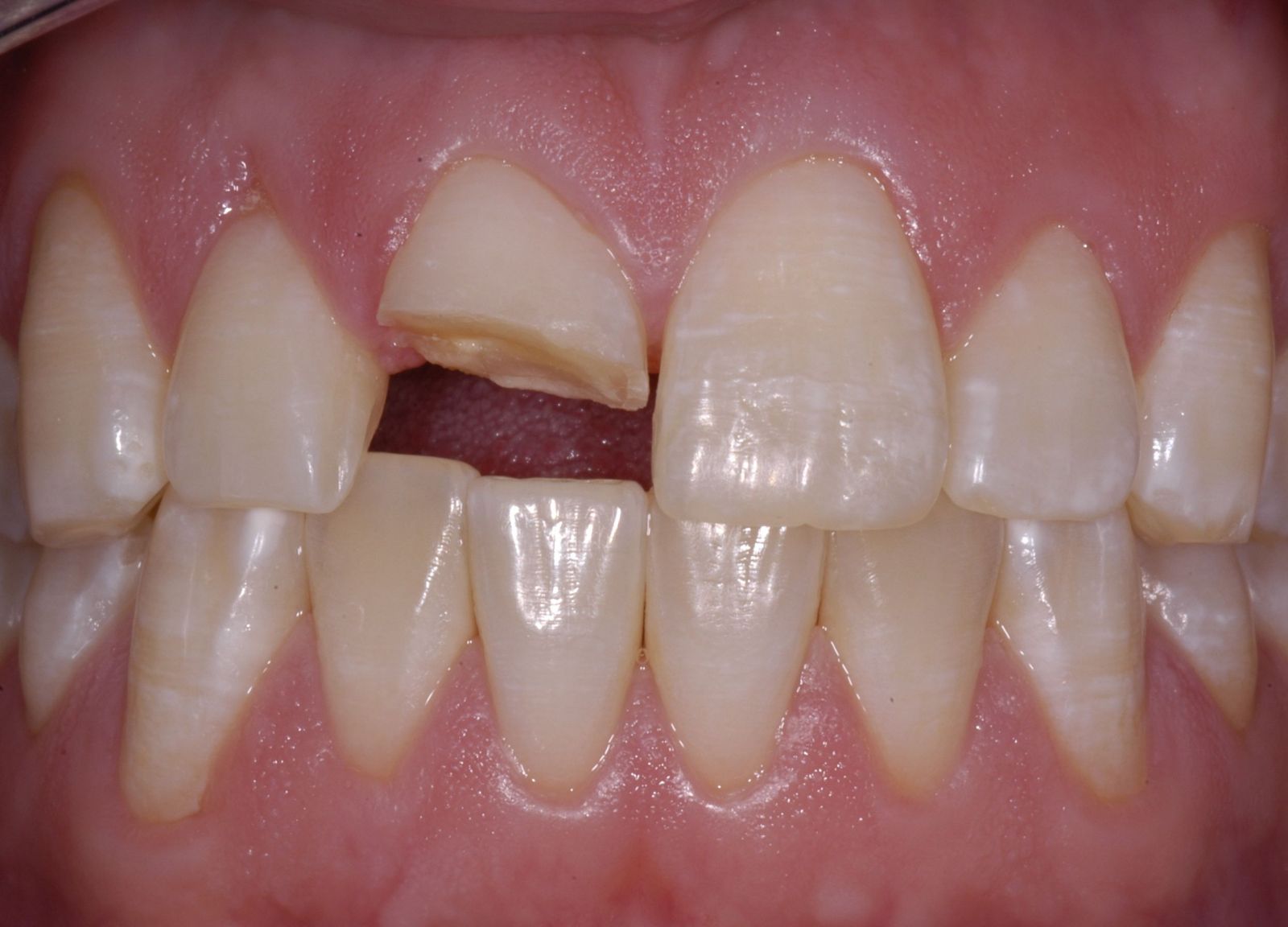 Tình trạng răng sứ bị mẻ vỡ phải làm sao? 1 Tình trạng răng sứ bị mẻ vỡ phải làm sao? 1