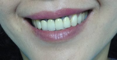 Thông tin về kỹ thuật bọc răng sứ titan 2