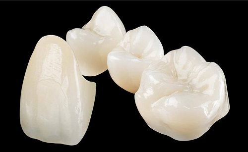Răng sứ venus - Giải pháp phục hình răng an toàn 1