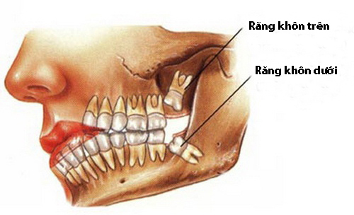 Tìm nguyên nhân đau răng khôn và cách xử lý phù hợp 1