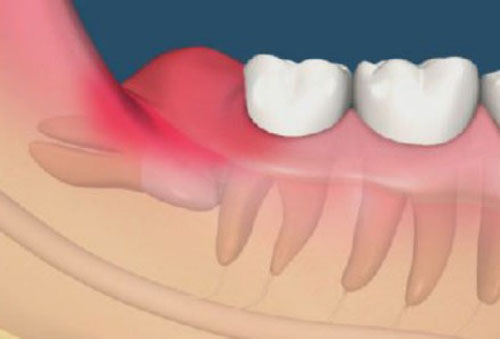  Mọc răng khôn uống thuốc gì để giảm sưng đau hiệu quả? 2
