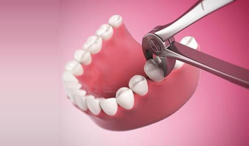 Nhổ răng khôn có ảnh hưởng gì không bác sĩ? 2