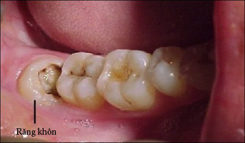 Răng khôn bị sâu phải làm sao để khắc phục? 1