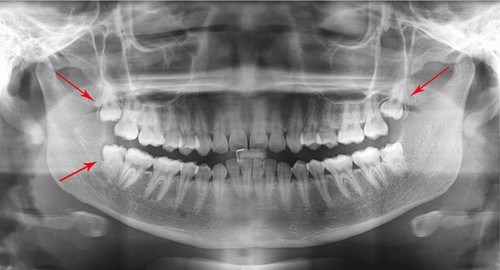 Răng khôn mọc lệch ra má có nên nhổ hay không? 1