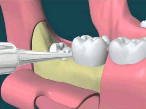 Răng khôn mọc lệch ra má có nên nhổ hay không? 3