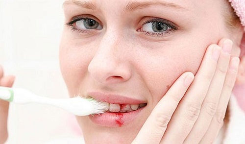 Chảy máu chân răng có gây hôi miệng không? 1