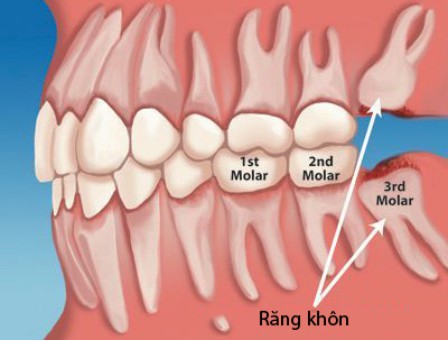 Mọc răng khôn gây hôi miệng - Nguyên nhân và cách khắc phục 1
