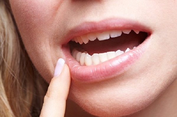Mọc răng khôn gây hôi miệng - Nguyên nhân và cách khắc phục 2