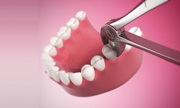 Tìm hiểu phương pháp nhổ răng hàm không đau 1