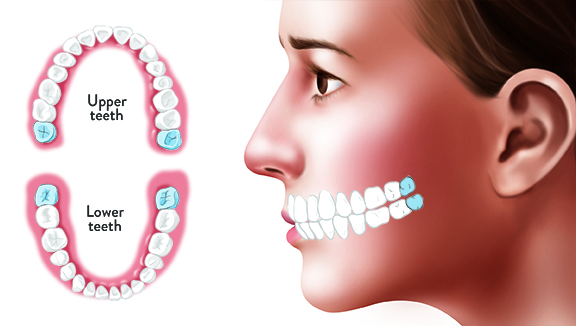 Răng khôn chưa mọc có ảnh hưởng gì không? 1