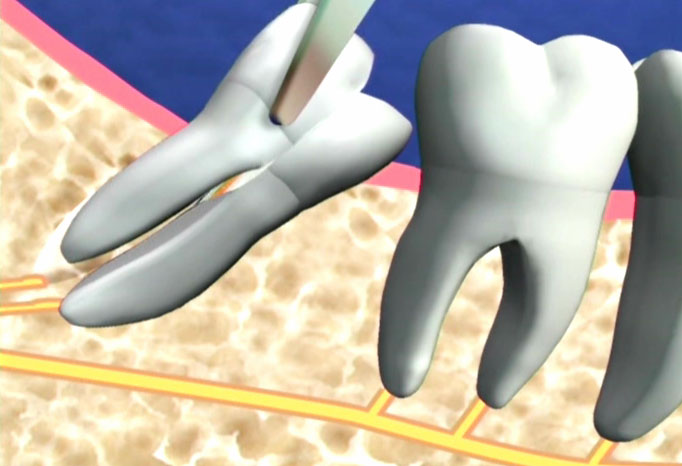 Tình trạng răng khôn hàm dưới mọc lệch có sao không? 3