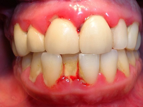 Sưng nướu răng - Nguyên nhân và cách điều trị 1