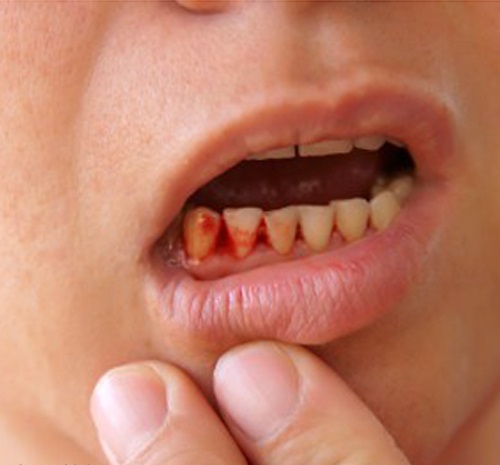 Chảy máu chân răng ở trẻ em có nguy hiểm hay không? 1