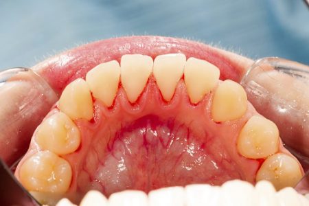 Tìm hiểu 5 dấu hiệu viêm chân răng cơ bản nhất 1
