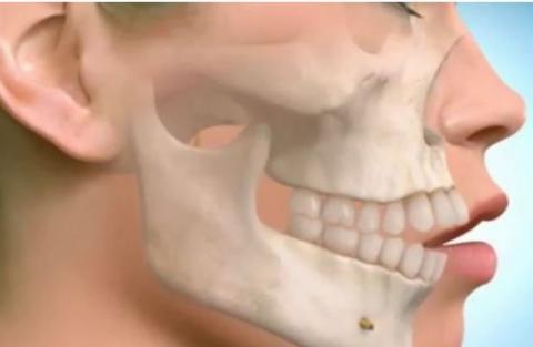 Tìm hiểu về kỹ thuật niềng răng hô hàm trên 1