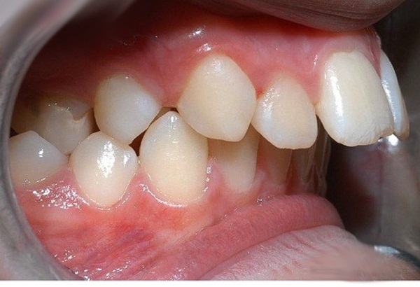 Tìm hiểu về kỹ thuật niềng răng hô hàm trên 2