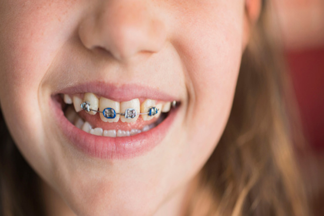 Tìm hiểu về kỹ thuật niềng răng hô hàm trên 3