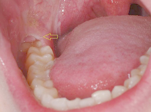 Nguyên nhân và dấu hiệu sưng nướu răng khôn 1