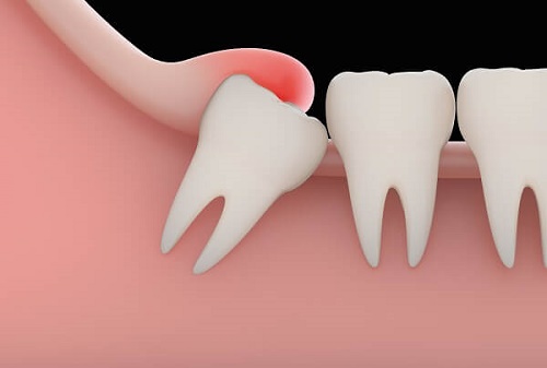 Nguyên nhân và dấu hiệu sưng nướu răng khôn 2