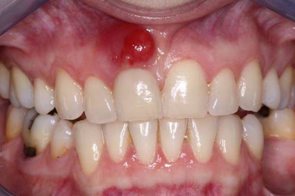 Bệnh lý viêm chân răng có mủ nguy hiểm không? 1 Bệnh lý viêm chân răng có mủ nguy hiểm không? 1