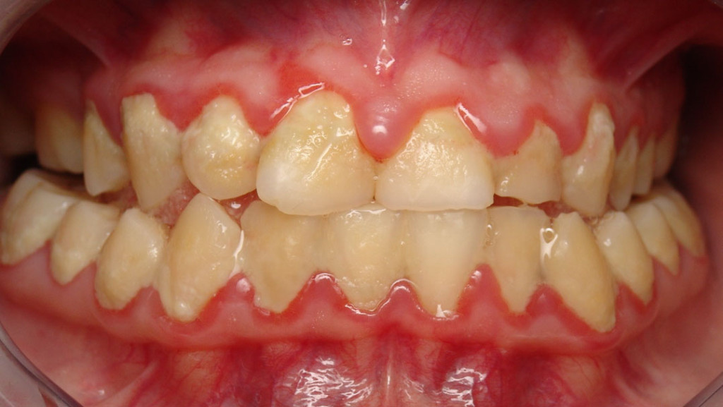 Bệnh lý viêm chân răng có mủ nguy hiểm không? 2