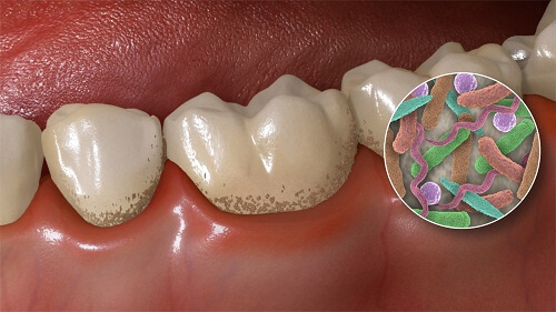 Bệnh lý viêm chân răng có mủ nguy hiểm không? 3