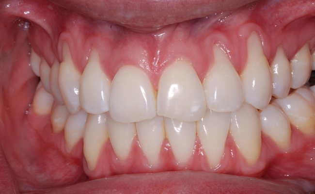Bị viêm chân răng có nguy hiểm không? 1