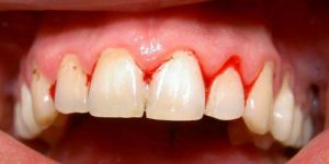 Chữa viêm lợi chảy máu chân răng dứt điểm 1