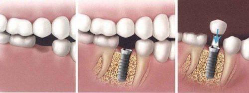 Quy trình cấy ghép răng implant như thế nào? 3