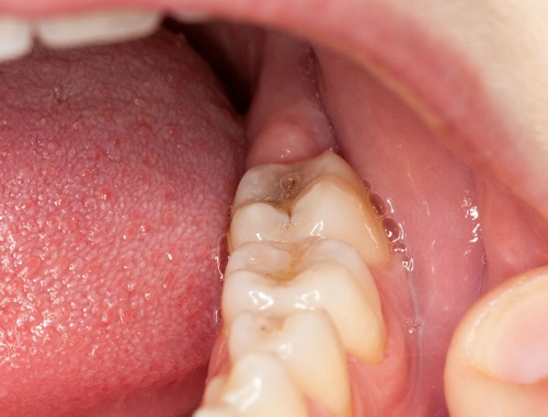 Áp xe răng là gì? Tình trạng áp xe răng khôn 2
