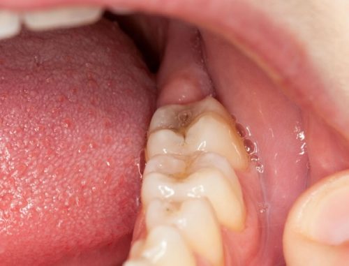 Viêm lợi trùm răng khôn do đâu? 1