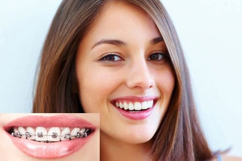 Niềng răng có hết hô không bác sĩ? 2