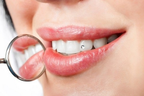 Đính đá vào răng có hại không? Cần những thông tin chi tiết 1