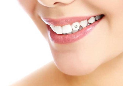 Đính đá vào răng có hại không? Cần những thông tin chi tiết 2