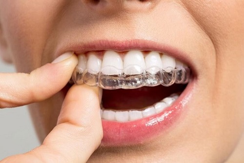 Niềng răng bằng nhựa hiệu quả có cao không