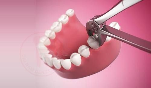 Niềng răng hô có cần nhổ răng không? Vì sao-1 Niềng răng hô có cần nhổ răng không? Vì sao