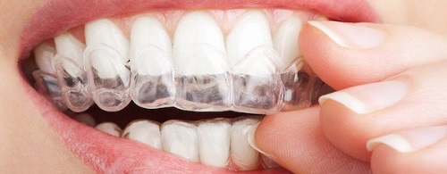 Niềng răng invisalign có đau không? Khách hàng nói gì về dịch vụ này