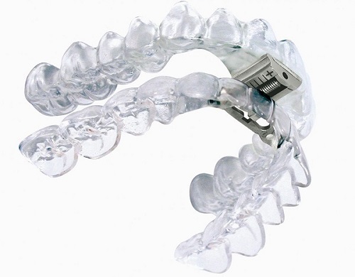 Niềng răng invisalign có đau không? Khách hàng nói gì về dịch vụ này