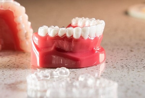 Niềng răng không mắc cài clear aligner nhiều ưu điểm vượt trội