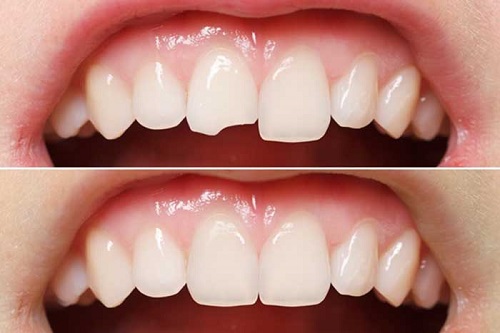Trám răng có phải lấy tủy không? Cần chuyên gia tư vấn 3
