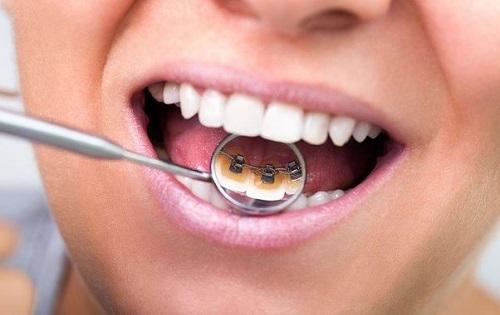 Niềng răng có làm răng yếu đi không? Có tổn hại gì cho răng không