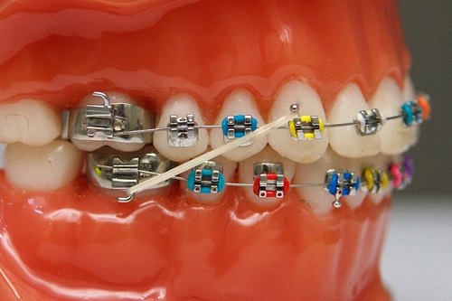 Niềng răng có làm răng yếu đi không? Có tổn hại gì cho răng không