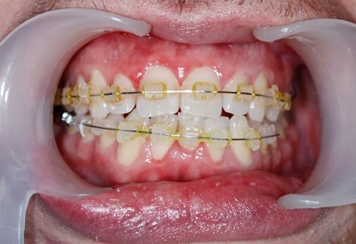 Răng hàm dưới mọc lệch lạc - Niềng răng hàm dưới bao nhiêu tiền