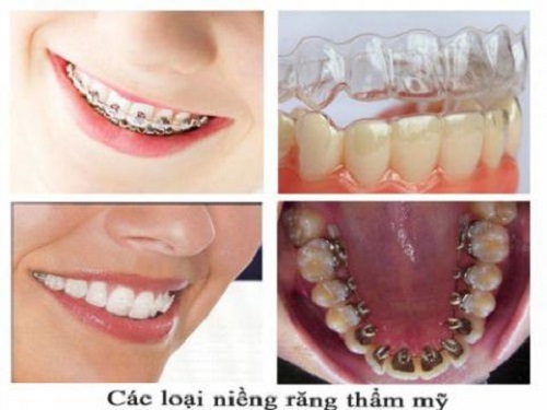 Niềng răng khểnh mất bao lâu là răng đều lại?